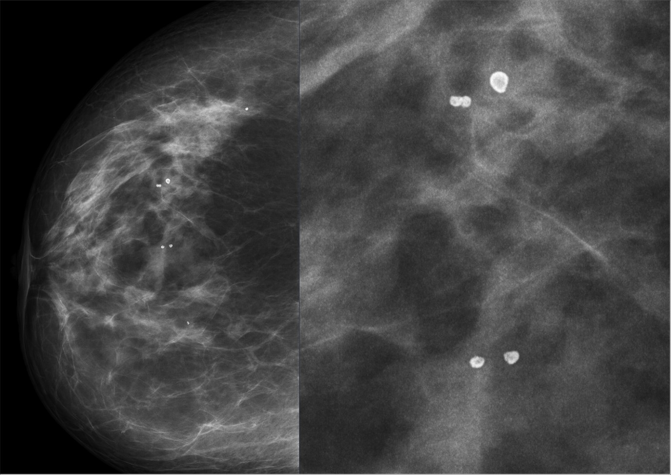 Lunit acquires Volpara to enhance AI-driven breast cancer care